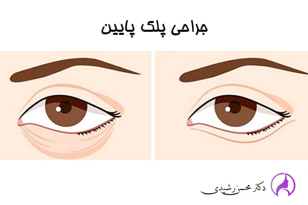 جراحی پلک - دکتر محسن رشیدی در زاهدان