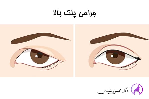 جراحی پلک - دکتر محسن رشیدی در زاهدان