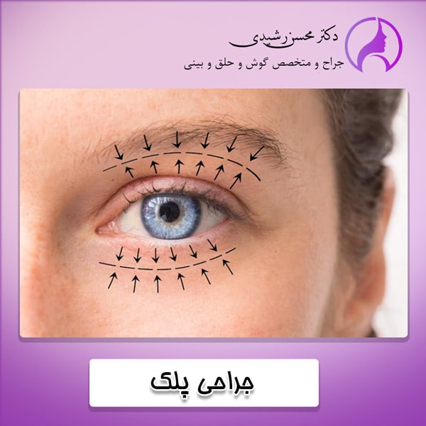جراحی پلک - دکتر محسن رشیدی در زاهدان