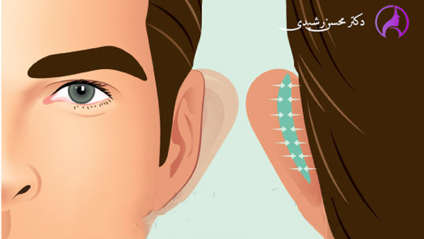 جراحی زیبایی گوش - دکتر محسن رشیدی زاهدان