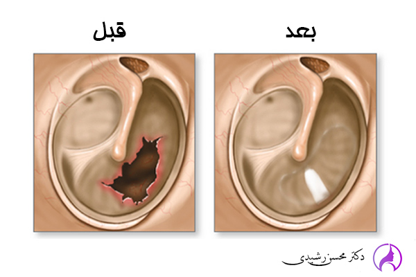 ترمیم پرده گوش - دکتر محسن رشیدی زاهدان