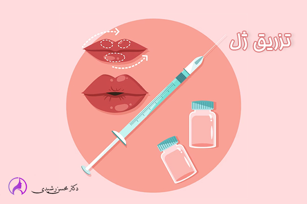 تزریق ژل در زاهدان - دکتر محسن رشیدی