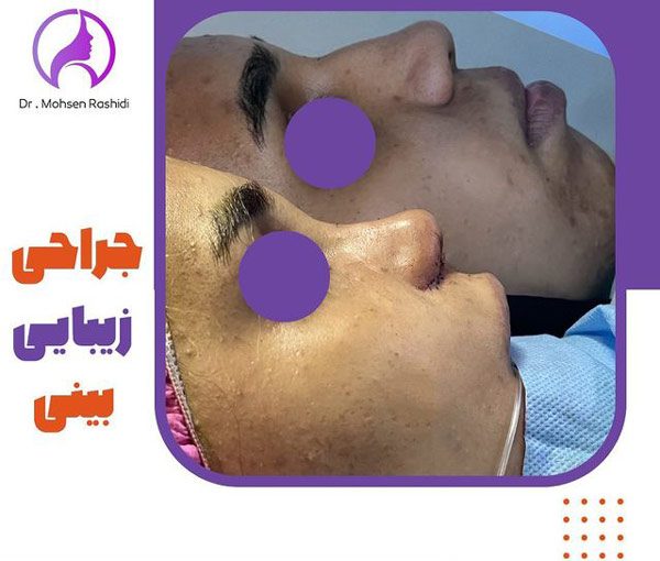 جراحی بینی ترمیمی در زاهدان - دکتر محسن رشیدی