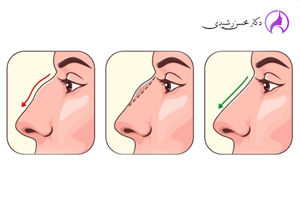 جراحی بینی در زاهدان - دکتر محسن رشیدی