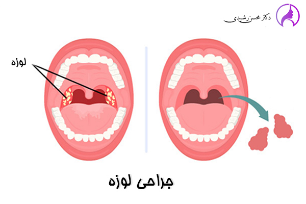 جراحی لوزه در زاهدان - دکتر محسن رشیدی