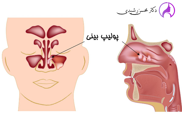 پولیپ بینی در زاهدان - دکتر محسن رشیدی