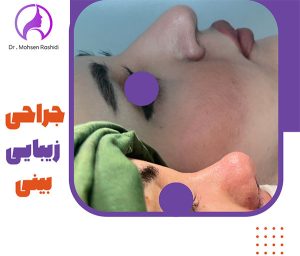 جراحی بینی در زاهدان - دکتر محسن رشیدی
