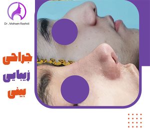 جراحی بینی در زاهدان - دکتر محسن رشیدی
