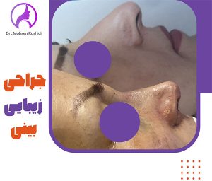 جراحی بینی در زاهدان - دکتر محسن رشیدی