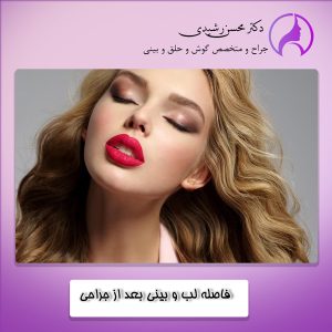 دلایل ایجاد فاصله بین لب و بینی بعد از جراحی بینی - دکتر محسن رشیدی