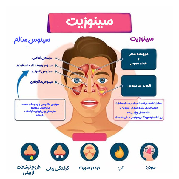 سینوزیت - دکتر رشیدی