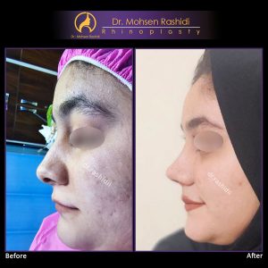 جراحی بینی نیمه فانتزی در زاهدان - دکتر رشیدی