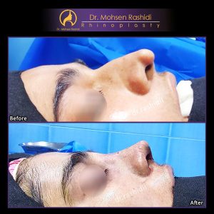 جراحی بینی نیمه فانتزی در زاهدان - دکتر رشیدی