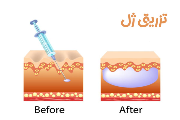تزریق ژل در زاهدان - دکتر رشیدی