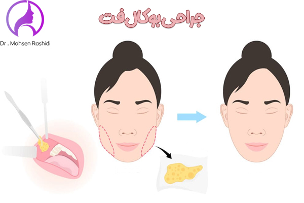 جراحی بوکال فت در زاهدان - دکتر محسن رشیدی