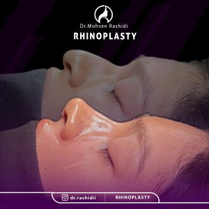 جراحی بینی در زاهدان - دکتر محسن رشیدی