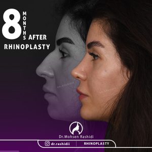 جراحی بینی در زاهدان - دکتر محسن رشیدی