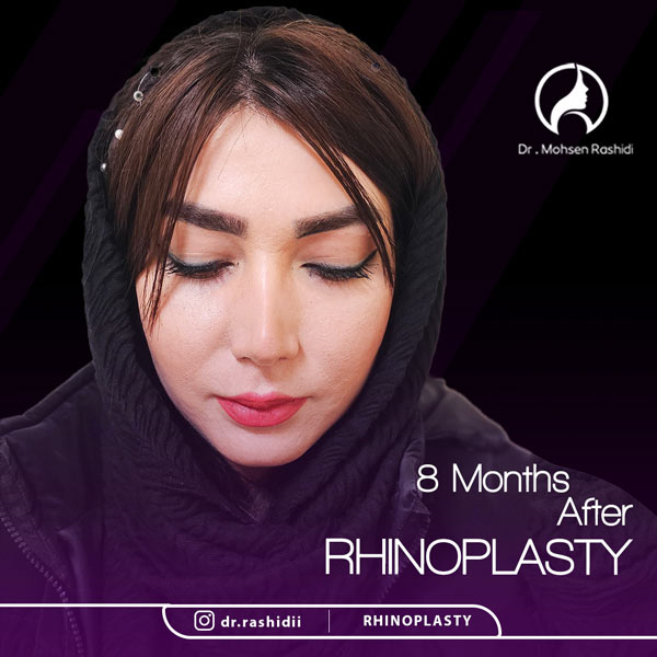 جراحی بینی استخوانی در زاهدان - دکتر رشیدی