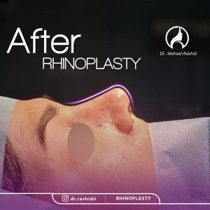 جراحی بینی استخوانی در زاهدان - دکتر رشیدی