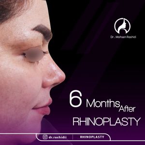 جراحی بینی استخوانی در زاهدان - دکتر رشیدی