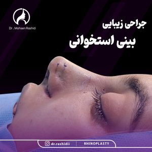 جراحی بینی استخوانی در زاهدان - دکتر رشیدی