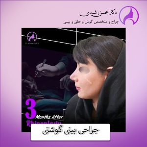 جراحی بینی گوشتی در زاهدان - دکتر محسن رشیدی 