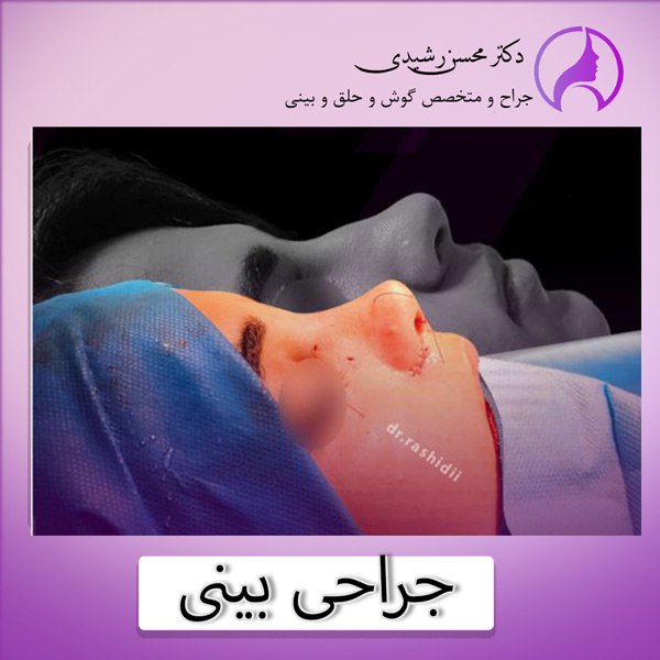 جراحی بینی در زاهدان - دکتر محسن رشیدی