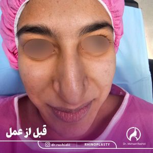 جراحی بینی در زاهدان - دکتر محسن رشیدی