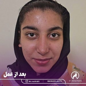 جراحی بینی در زاهدان - دکتر محسن رشیدی