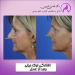 افتادگی نوک بینی بعد از عمل به چه علت است ؟